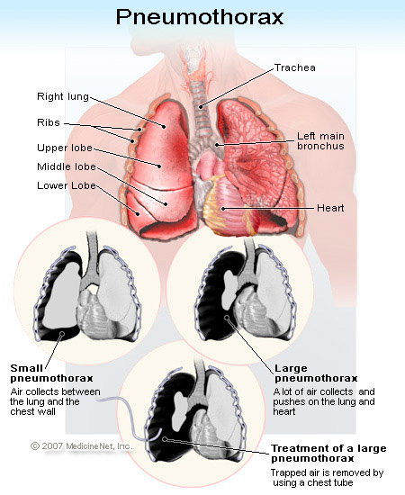 pneumothorax